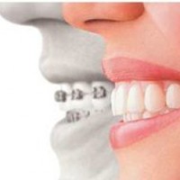 山西牙齿隐形矫正矫正价钱-专业牙齿矫正服务推荐