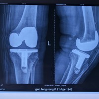 膝关节置换医院哪家好-有口碑的治疗膝关节置换推荐