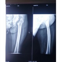 安丘股骨头置换医院-山东可靠的治疗股骨头坏死
