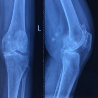 临朐膝关节置换医院-山东周到的治疗膝关节置换推荐