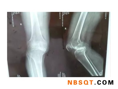 青州中药透皮治疗-哪里有提供口碑好的青州骨科治疗图1